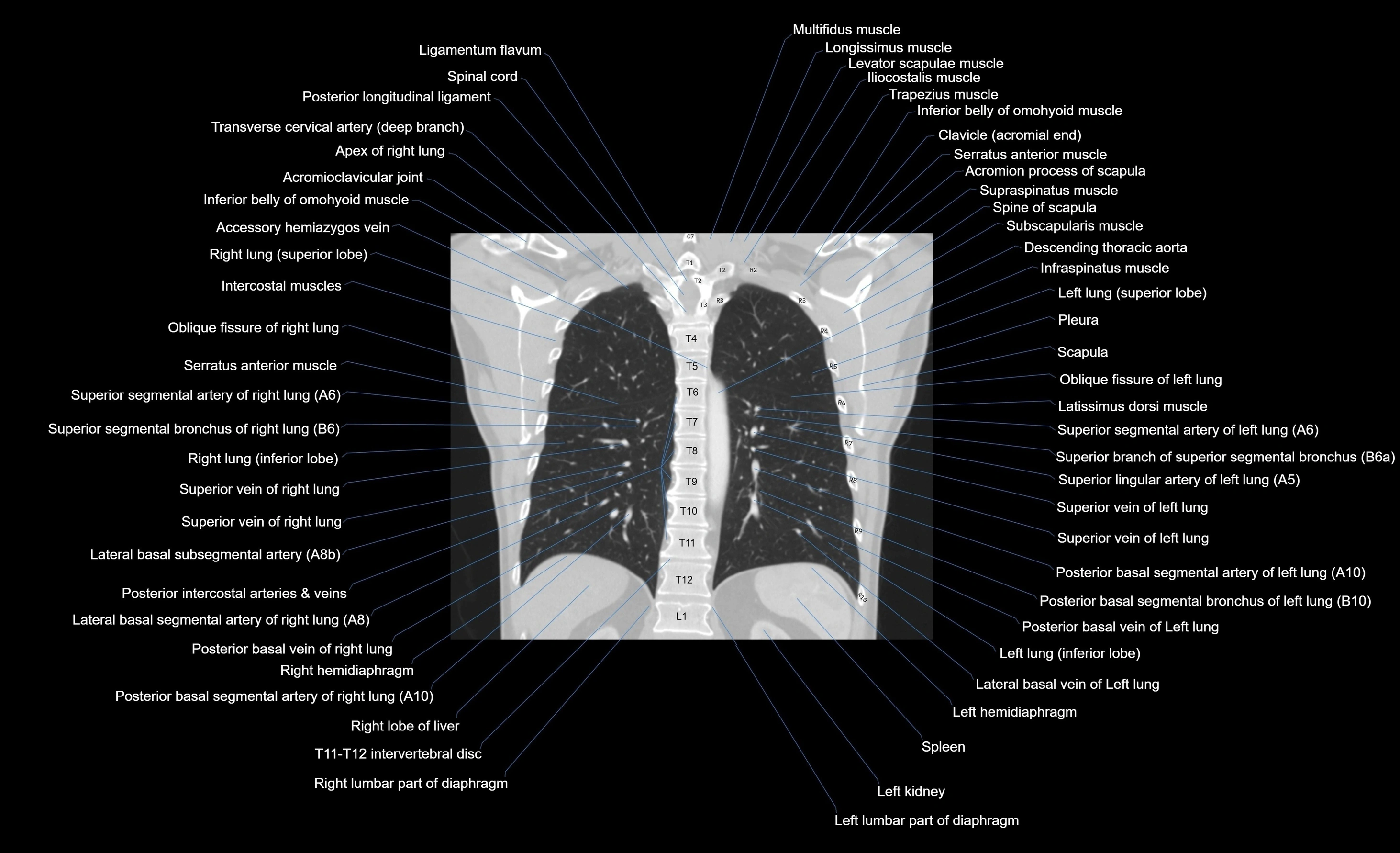 CT chest (thorax) lung window window labelled coronal cross sectional anatomy radiology image-00040.webp